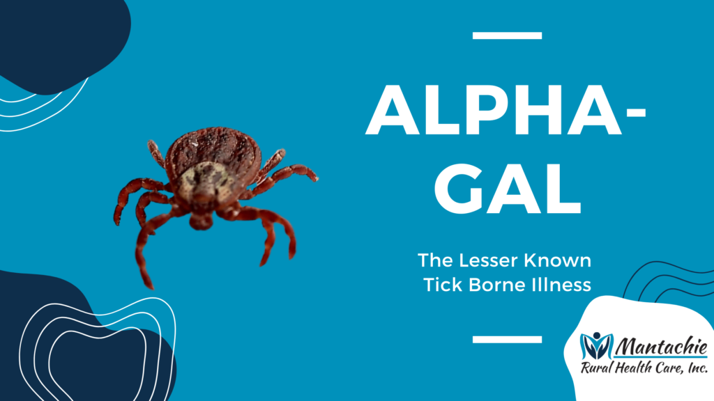 Alpha-Gal Allergy: The Lesser Known Tick Borne Illness